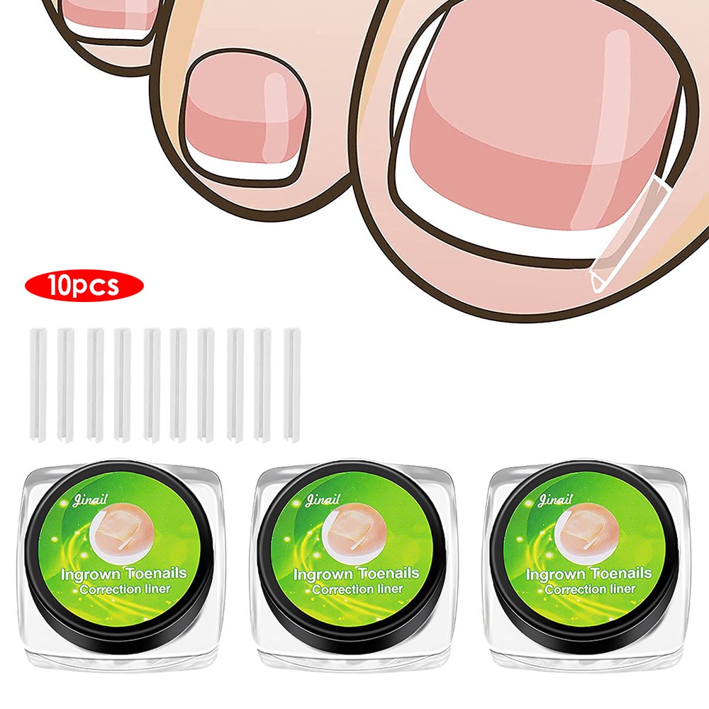 Pcs Set Portable Flexible Ingrown Toenail Corrector Disposable