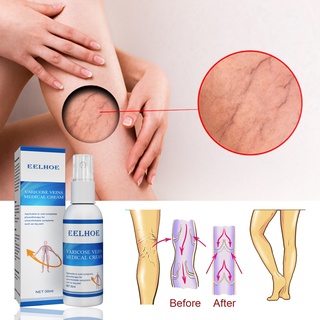 Eelhoe Venous Varicose Cream Spray Pain Relieving Spray Venous Massage