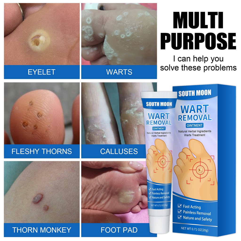 Warts Remover Ointment Genital Herpes Genital Condyloma Corn Removal