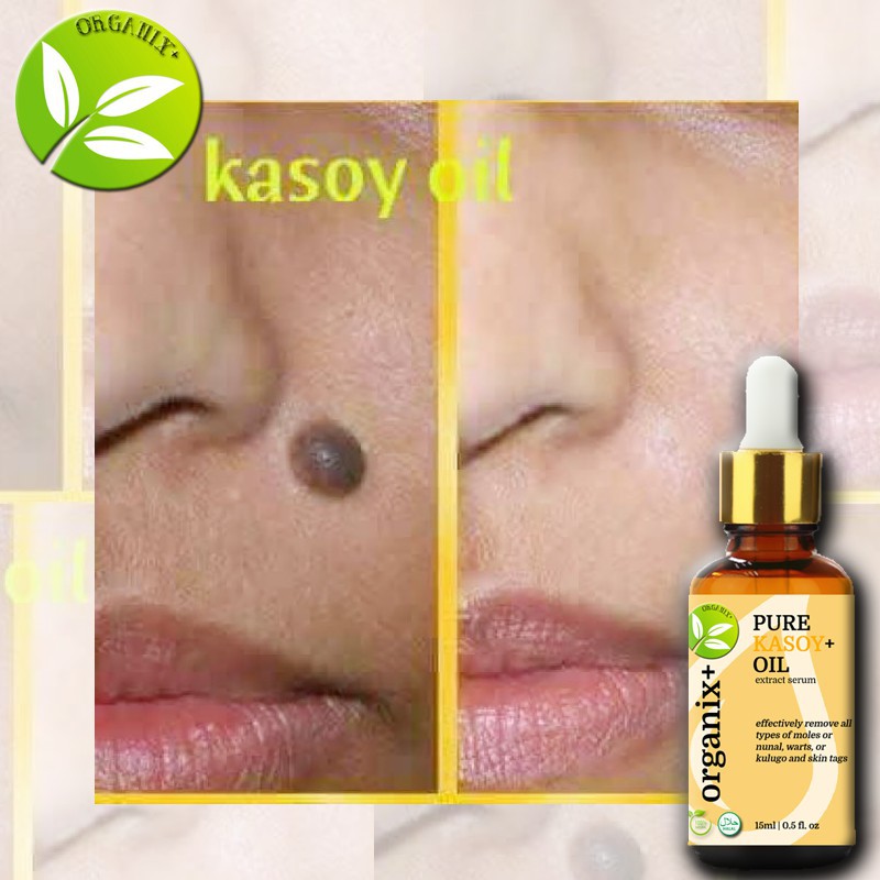 Warts Pure Organic Kasoy Oil For Warts Skin Tags Skin Growth Mole