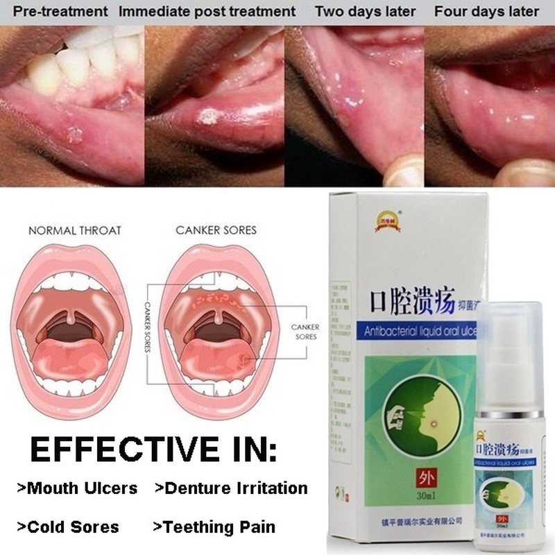 Mouth Ulcer Pain Relief Spray Anti Bacterial Treatment Hygiene Health