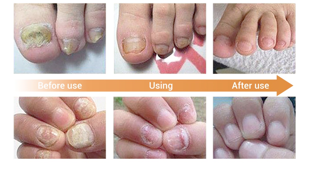 Lanbena Nail Repair Essence Serum Fungal Treatment Remove Onychomycosis