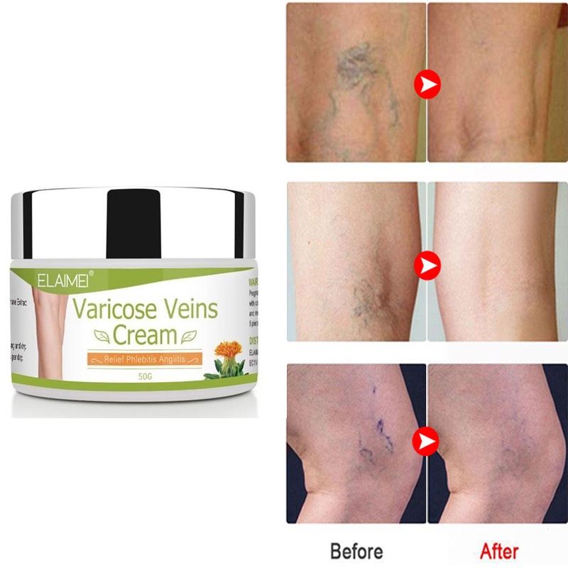 Varicose Vein Remover Spider Veins Removal Legs Red Blood Streak Repair