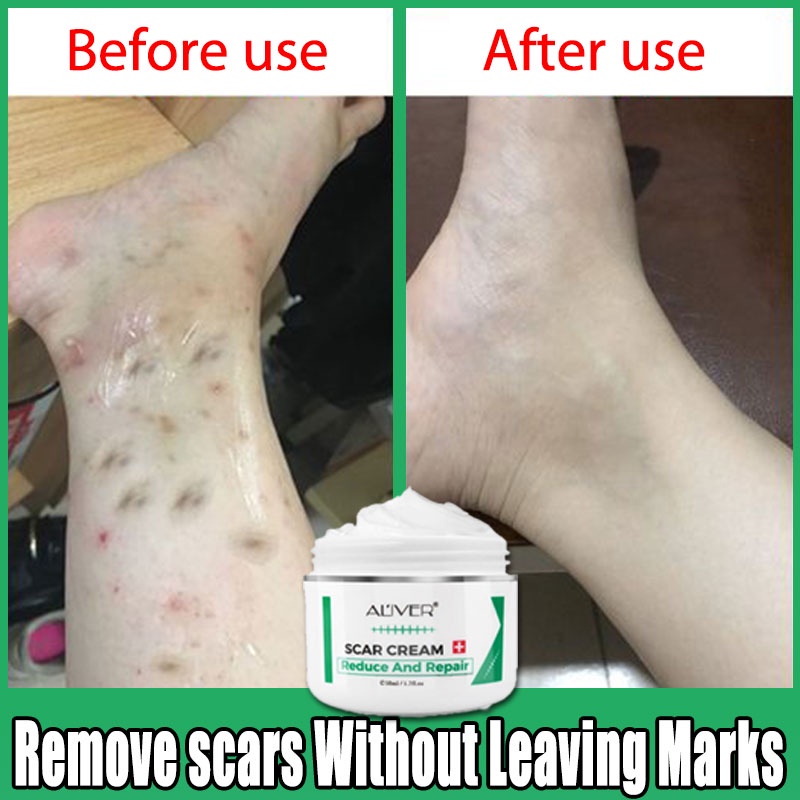 Aliver Old Scar Remover For Legs Ml Peklat Remover Acne Surgical