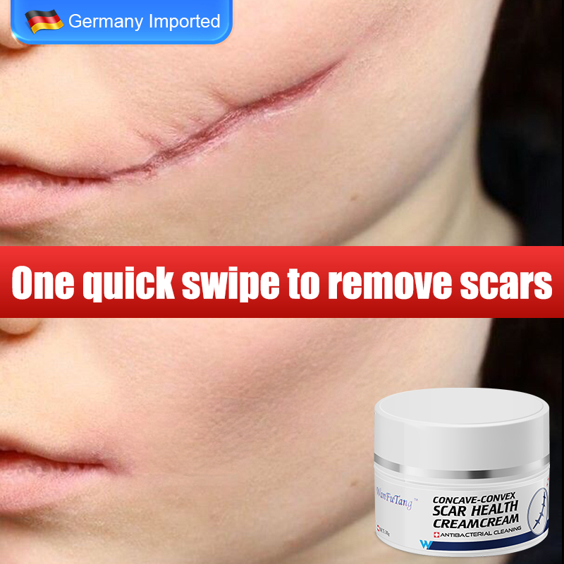 Scar Remover Cream For Old Scar Scarminator Cream Peklat Remover