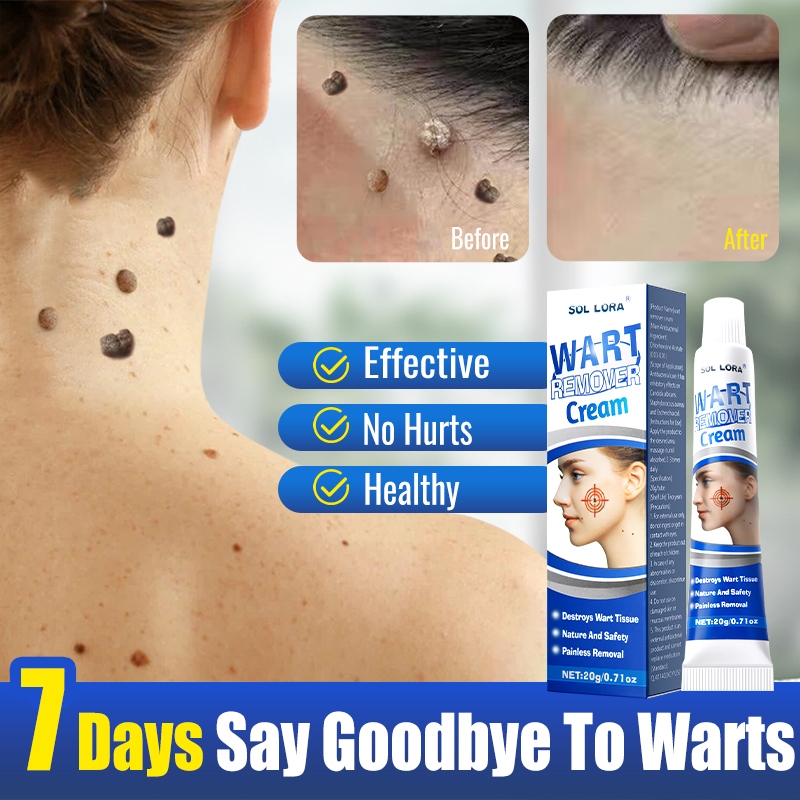 Warts Remover Original Cream Mole Remover Ointment Wart Painless Skin