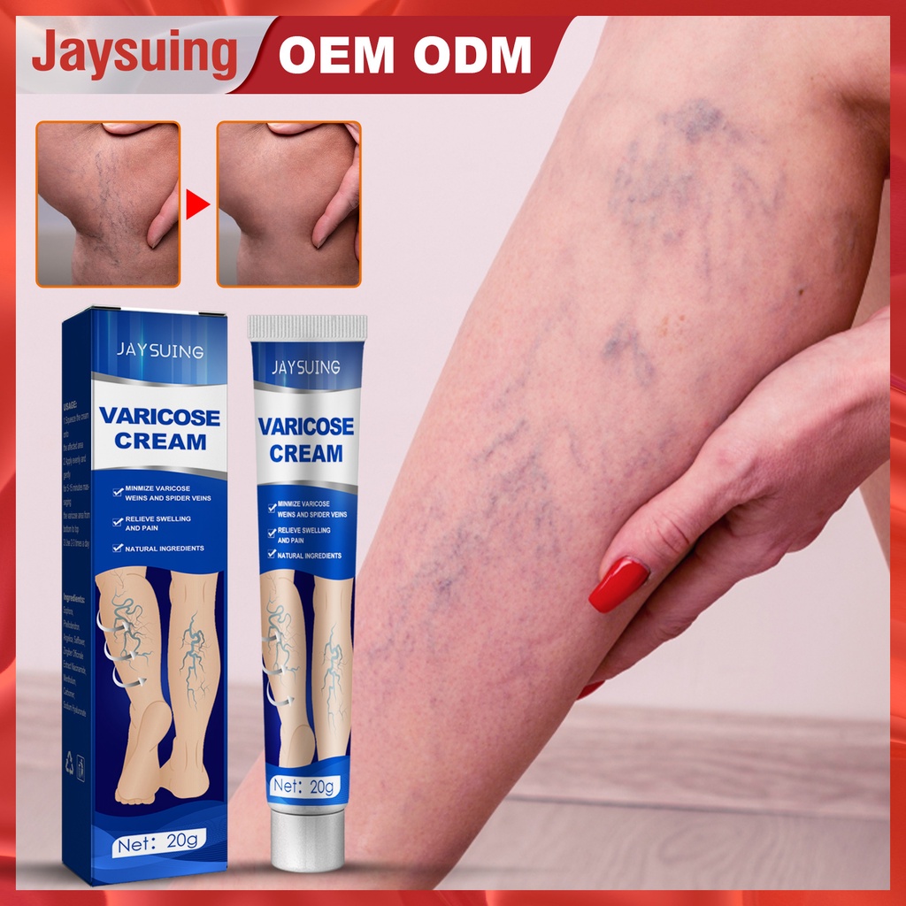 Varicose Vein Massage Cream Varicose Vein Relief Cream Vasculitis