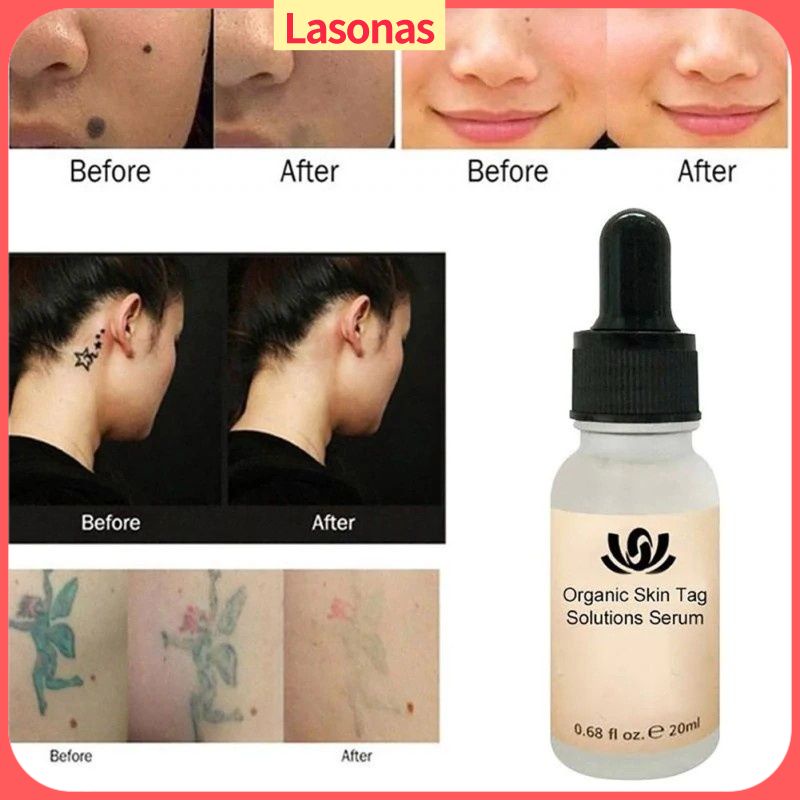 Organic Tags Solutions Serum Mole Skin Tag Removal Solution Painless