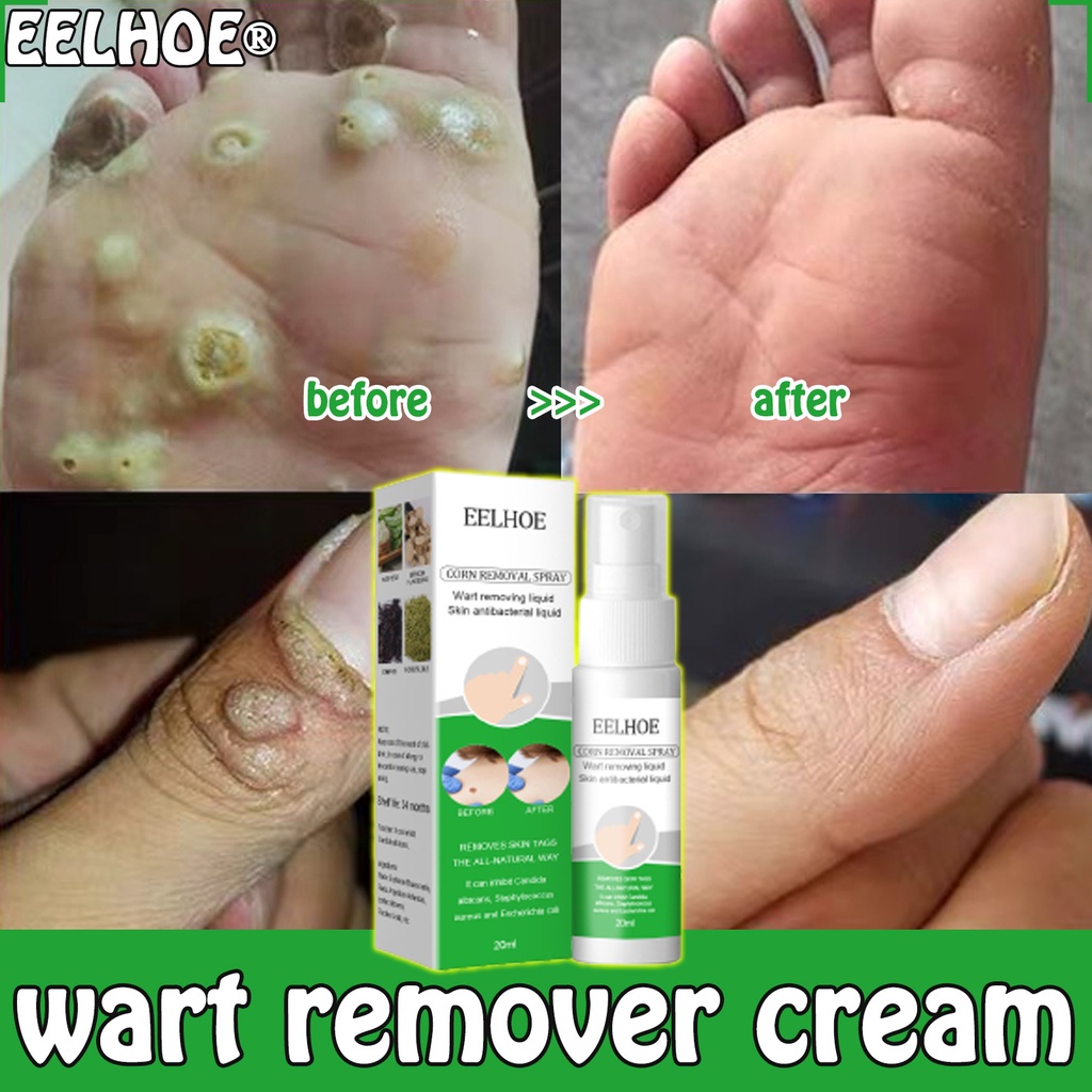 South Moon Warts Cream Remover Painless Shedding Antibacterial Wart