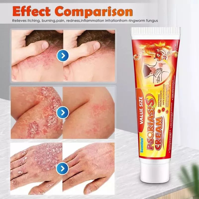 Original Sumifun Eczema Cream 60G Psoriasis Treatment Itchy Skin