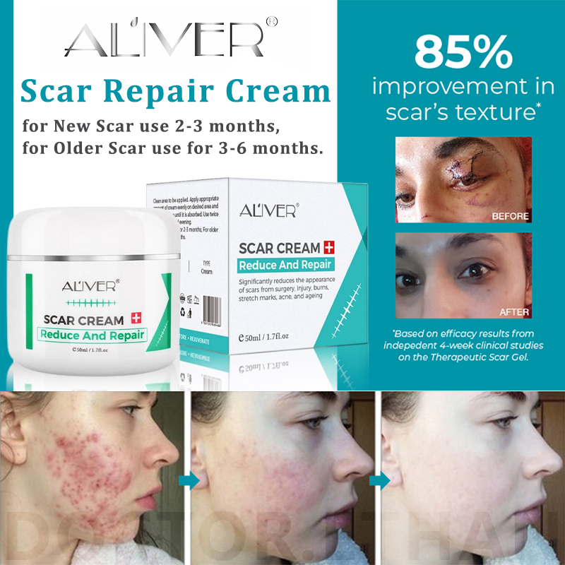 Aliver Scar Remover Cream For Legs Ml Peklat Remover Acne Surgical