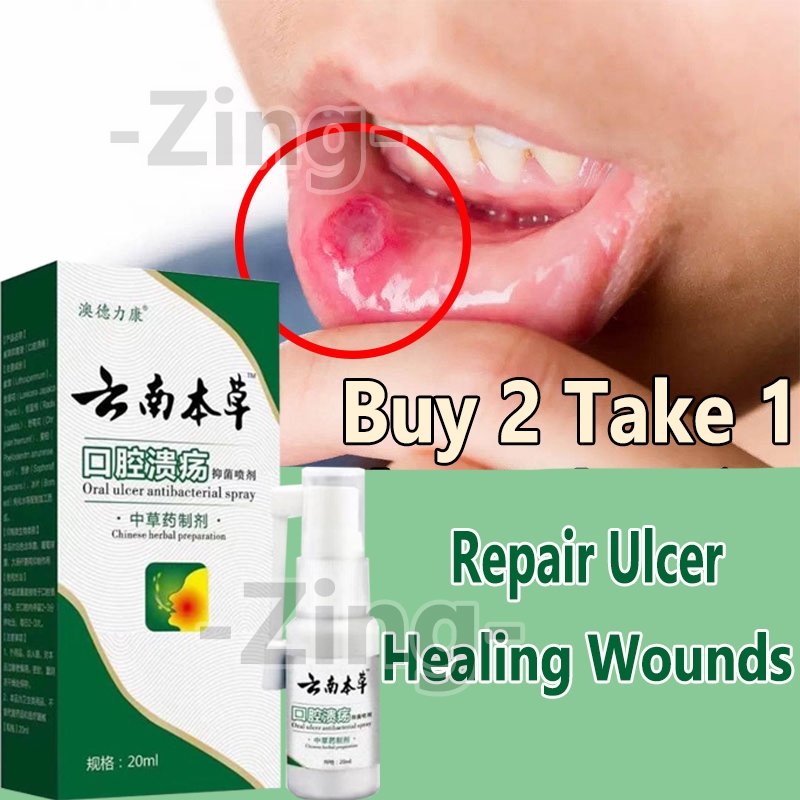 Canker Mouth Sore Solution Mouth Ulcer Treatment Spray Gamot Sa Singaw