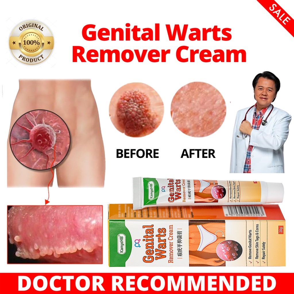 Warts Remover Ointment Genital Herpes Genital Condyloma Health Care