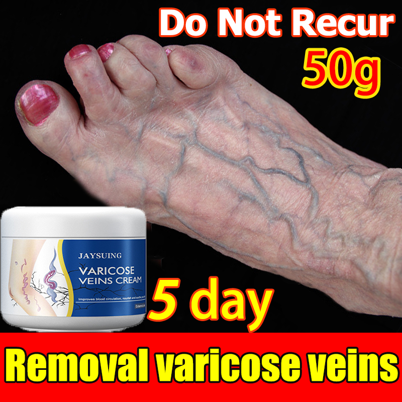 Jaysuing Varicose Vein Cream G Venous Massage Ointment Vasculitis