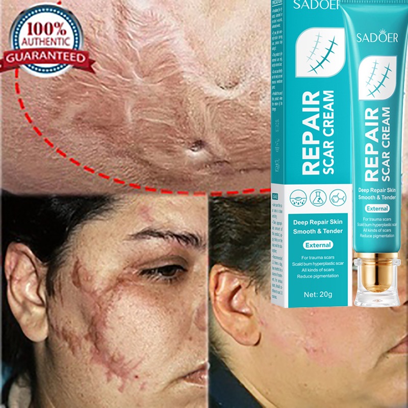 Scar Removal Cream Stretch Marks Peklat Remover Repair Old Scar Burns