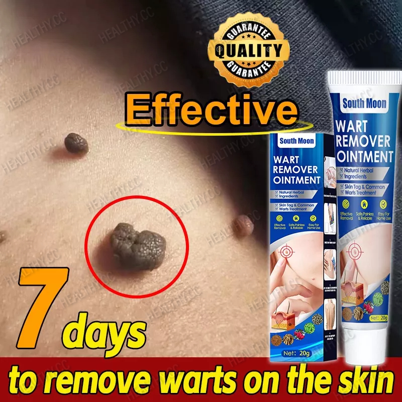 Warts Remover Original Cream Kasoy Oil Cream Kulugo Mole Skin Tag Wart