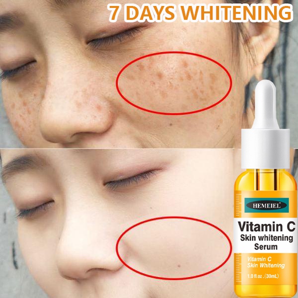 Hemeiel Vitamin C Serum Melasma Remover Melasma Removal Serum Brilliant