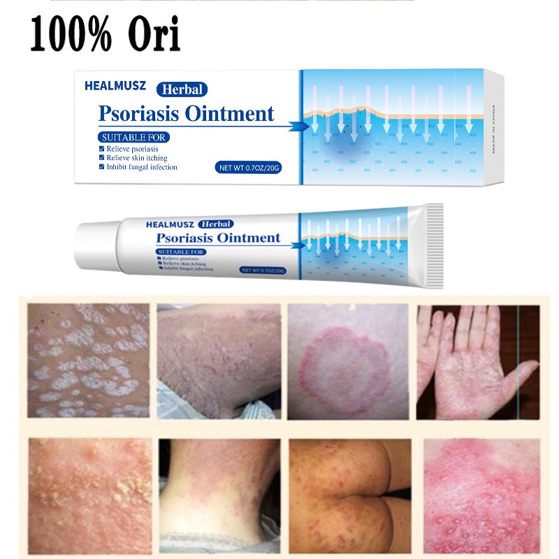 Psoriasis Antibacterial Cream Eczema Rash Treatment Dermatitis