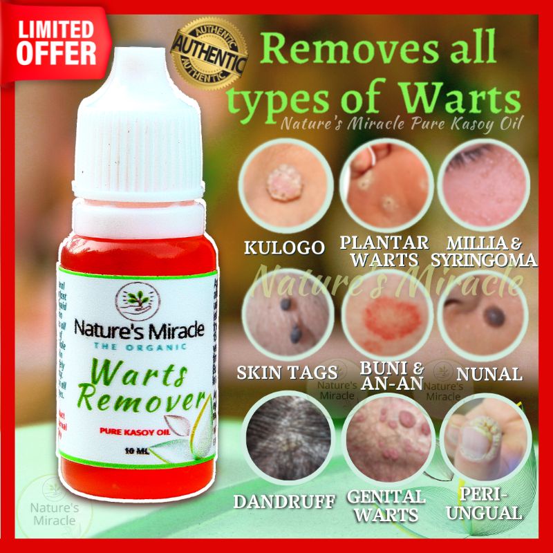 Effective Organic Pure Kasoy Oil Original Mole Warts Skin Tags