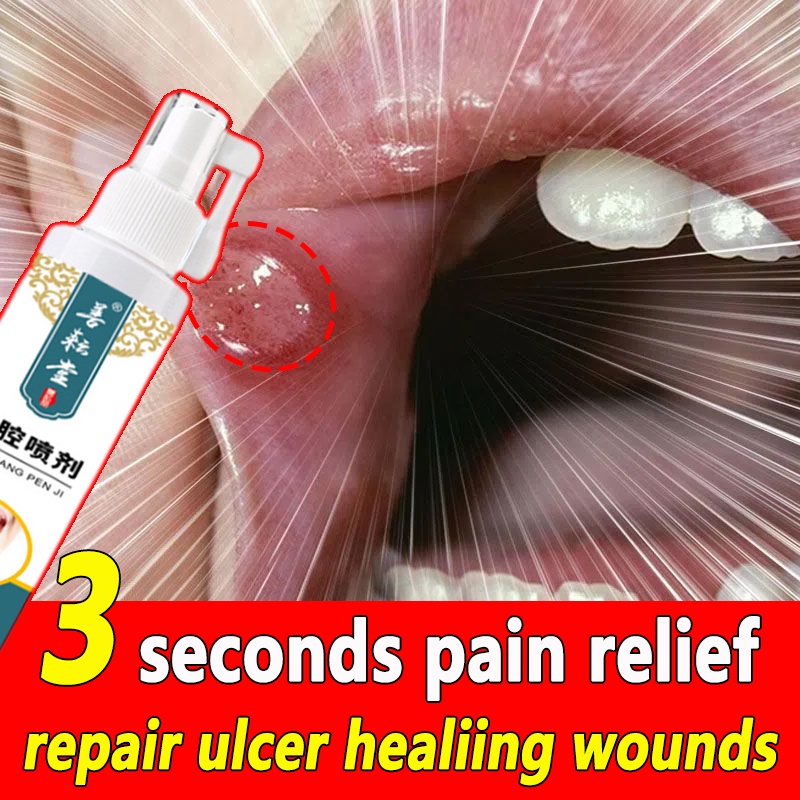 Canker Sore Spray 50ml Mouth Ulcer Treatment Canker Mouth Sore Solution