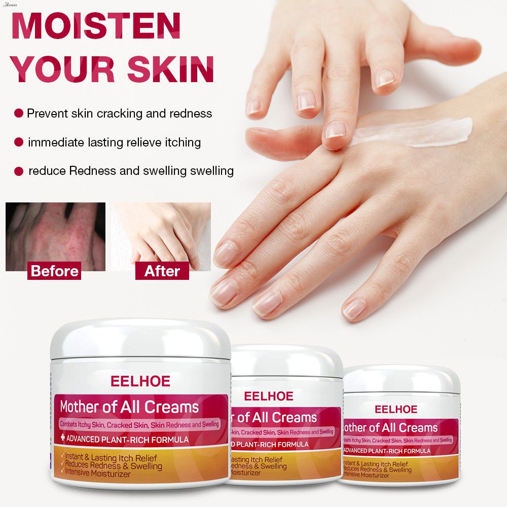 ACERVER In Stock Elhoe Eczema Cream Anti Itch Cream Skin Topical