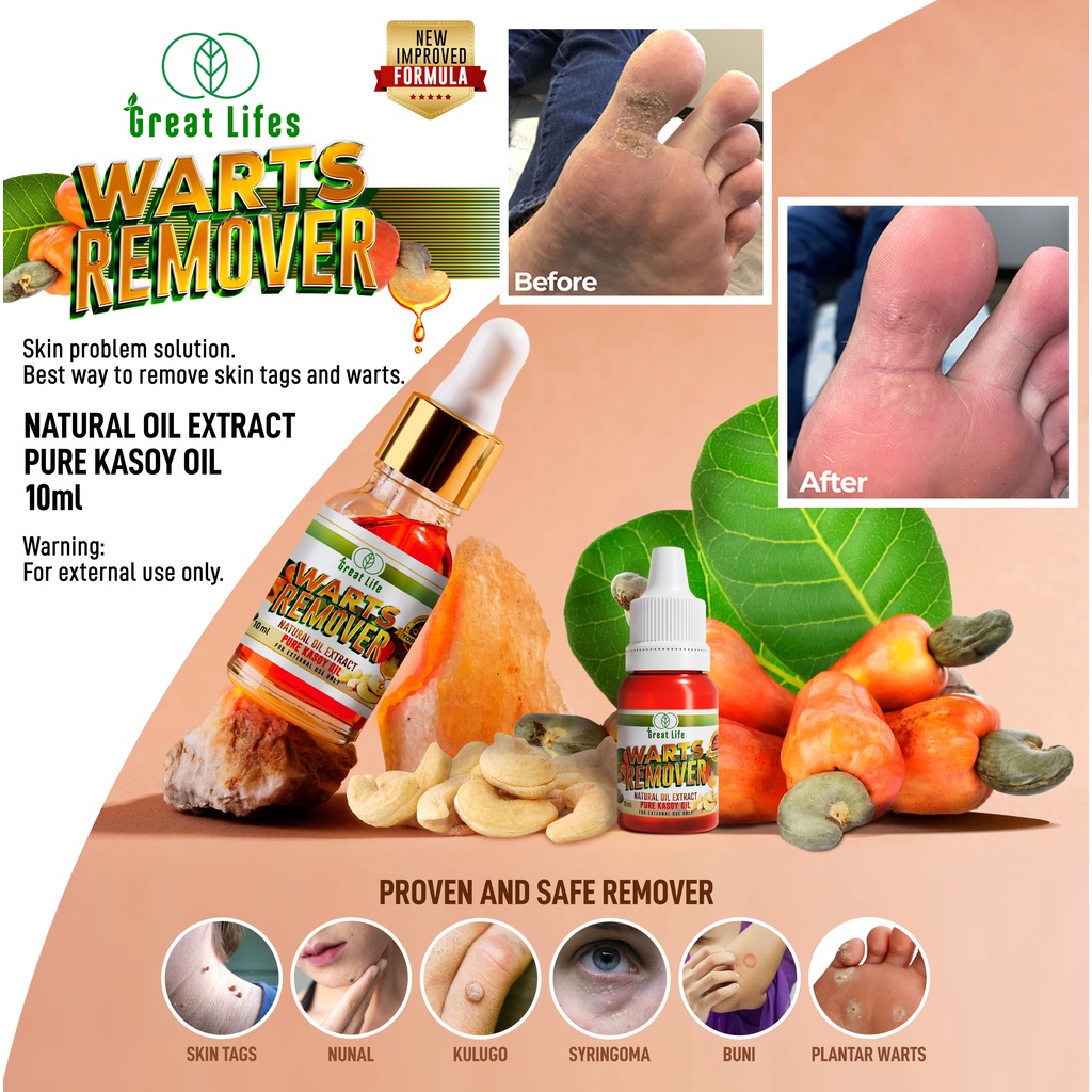 Buy Take Warts Rover Pure Kasoy Oil Mole Skin Tag Remover