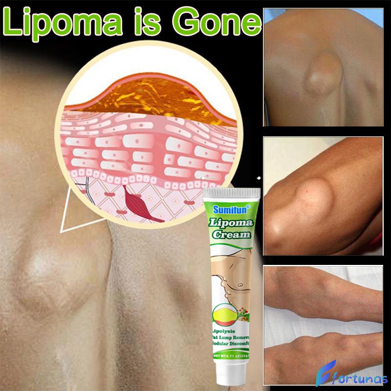 Sumifun Lipoma Removal Cream Original Lipoma Ointment Lump Fat Lump