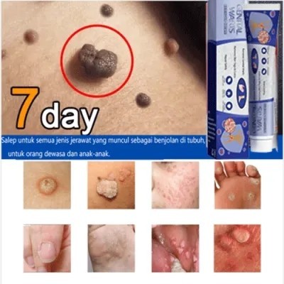 Warts Remover Original Cream Wart Removal Ointment Wart Treatment Skin