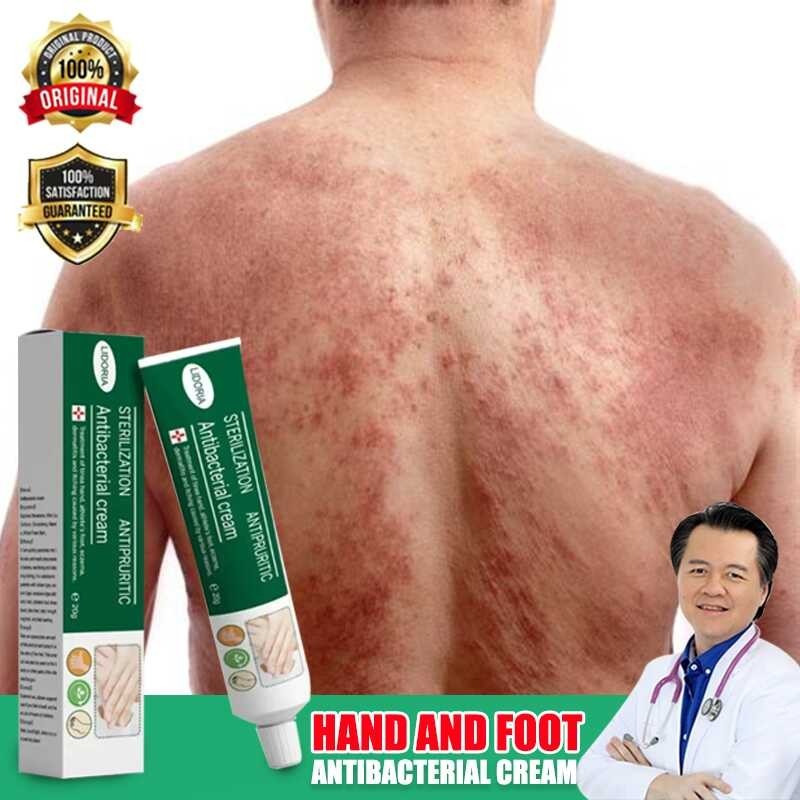 Gamot Sa Kati Kati Sa Balat Skin Fighter Atoderma Cream Original