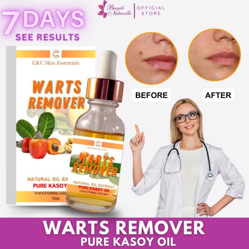 Original Pure Kasoy Oil Warts Remover Effective For Painless Removal