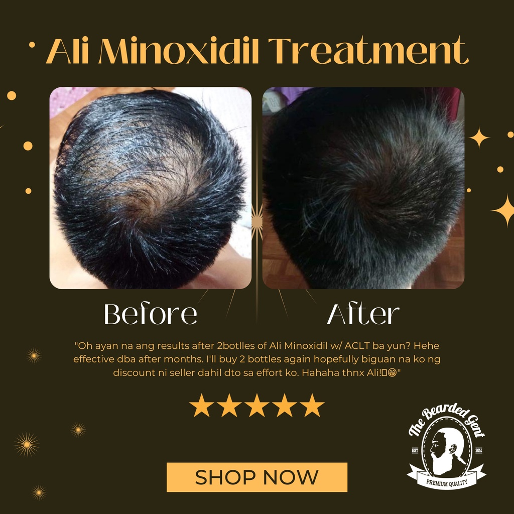 l carnitine tartrate for hair loss Advanced hair loss treatment