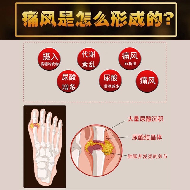 ℡Gout [Wake up and disappear] High uric acid, lowering uric acid ...