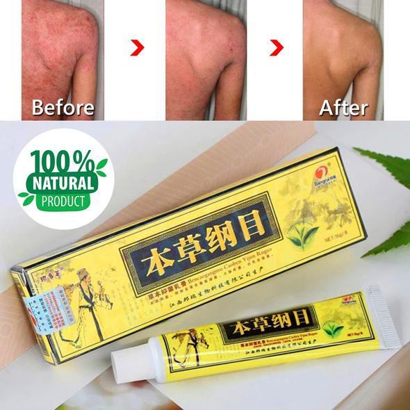 Mura ang Wumart Chinese Herbal eczema Psoriasis Cream Dermatitis And ...