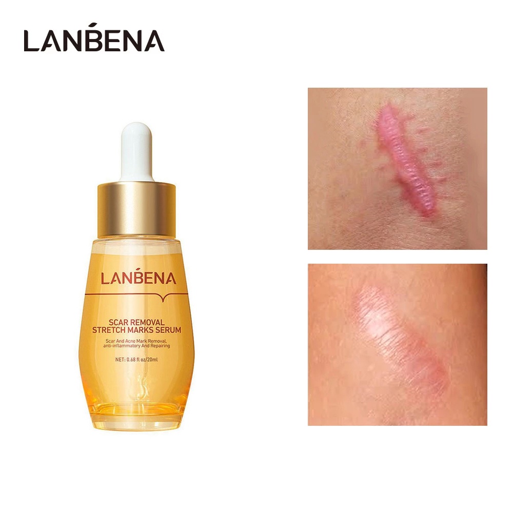 LANBENA Acne Scar Remove Serum Acne Treatment Remover Cream | Shopee