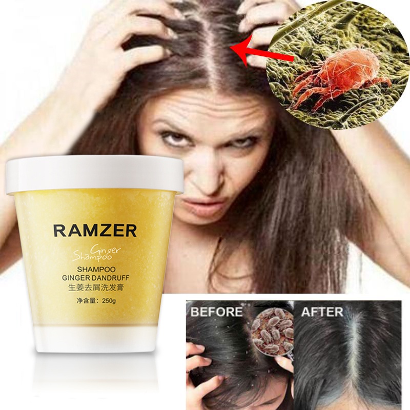 Ginger Dandruff Treatment Shampoo Sea Salt Scrub Antiitching Shampoo Mite Removal Psoriasis