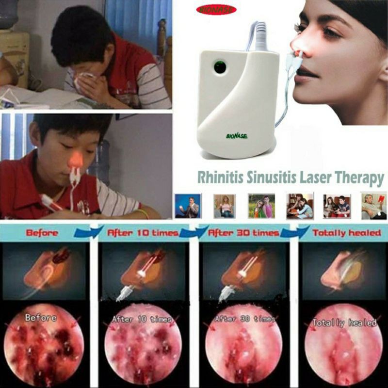 Allergic Rhinitis / Sinusitis Laser Treatment with free 9 volt battery! Shopee Philippines