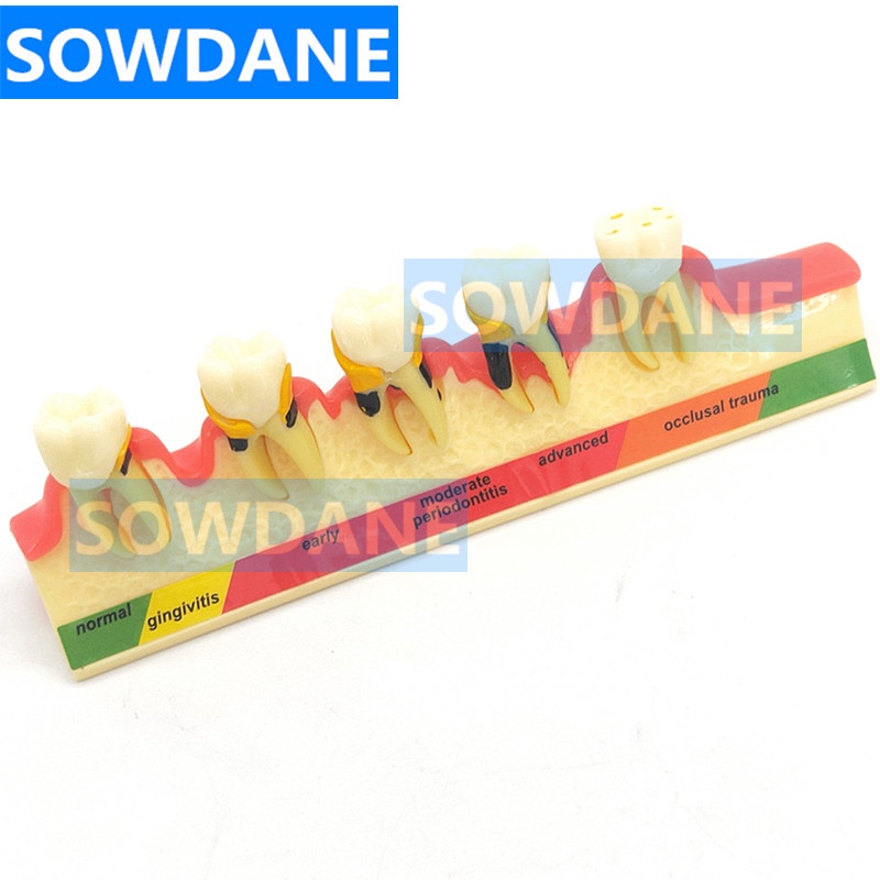 retainer braces ready to wear Dental Teeth Model Periodontal Disease