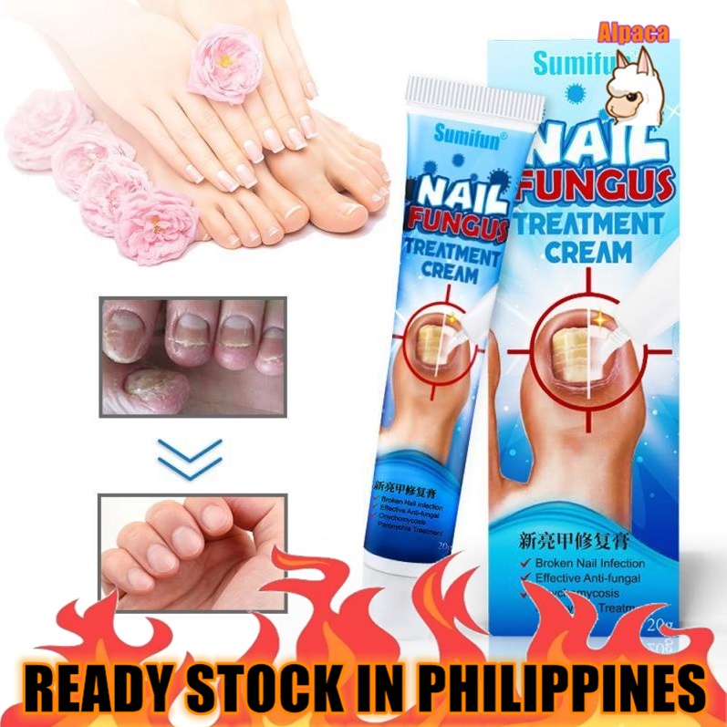 Antibacterial Cream Anti Fungal Cream Nail Fungus Treatment Paronychia