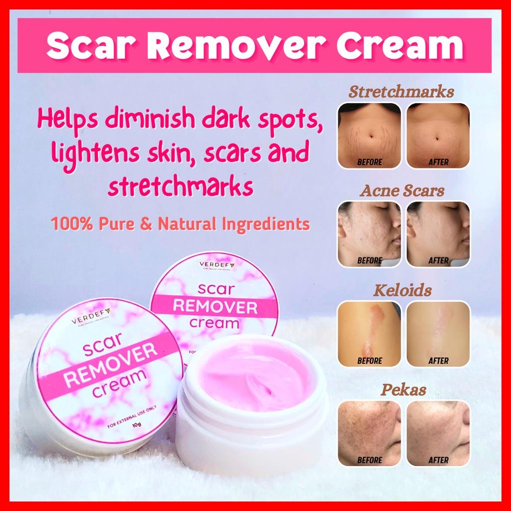 10g Scar Remover Cream / Keloid & Stretchmark Remover Cream (MIRACLE