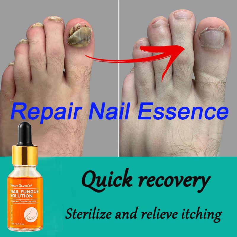 Nail Fungus Treatment Best Nail Repair Stop Fungal Growth Effective Fingernail Care Shopee
