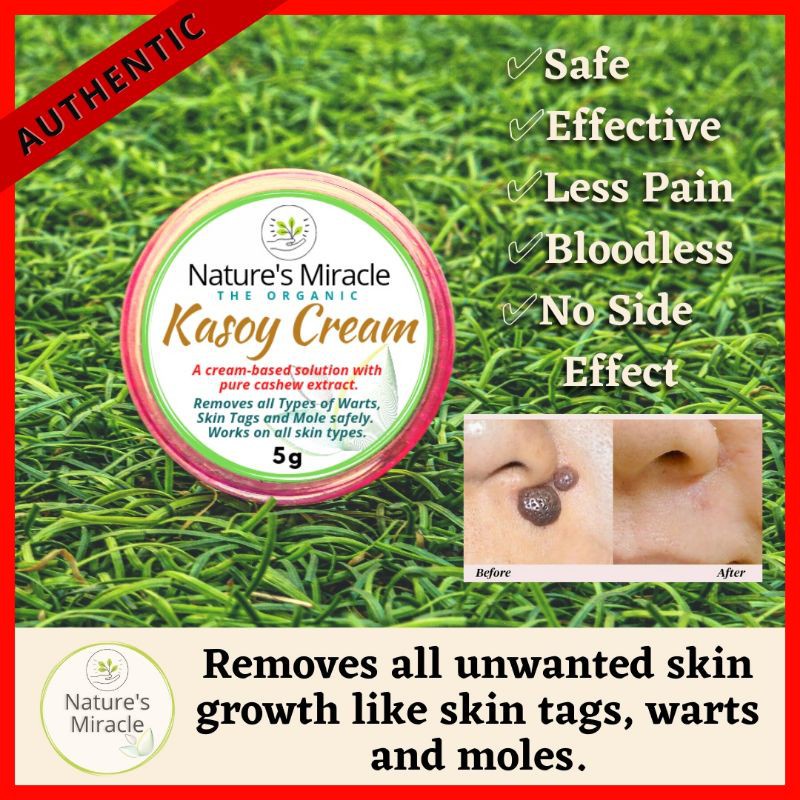 ☒Strong Kasoy Cream Warts Remover, Mole Remover, Skin Tags Remover 5g ...