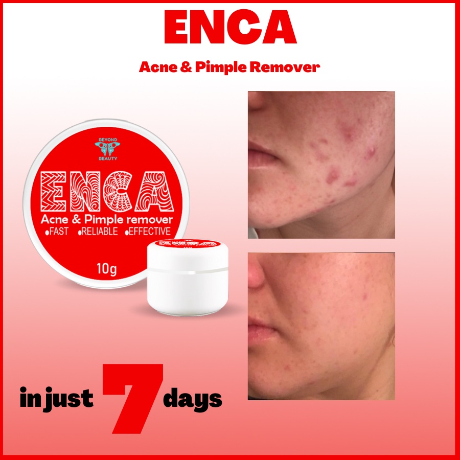 ENCA Effective Pimple & Acne Remover ( Acne Prone Skin / acne treatment
