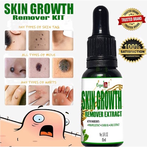 BEST QUALITY Skin Growth Remover Extract , syringoma removal cream ...