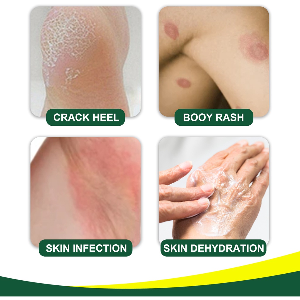 Female Private anti Itching Cream Anti Bacterial Ointment Dermatitis ...