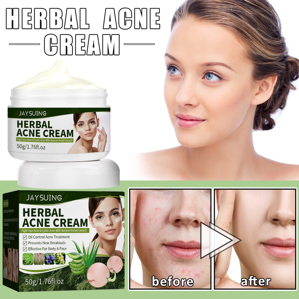 Jaysuing Herbal Purifying Acne Cream, Purifying Repairing Acne Pit 50g ...