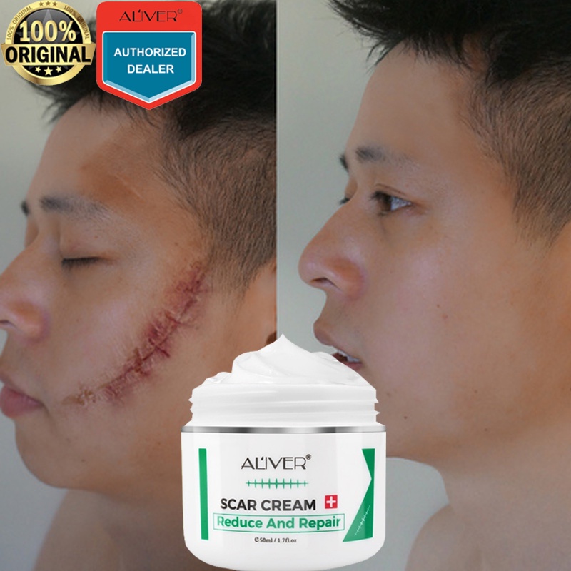 50ml Aliver Scar Removal Cream For New Old Scars Scar Gel Acne Scars Treatment Acne Scar Remover 5128