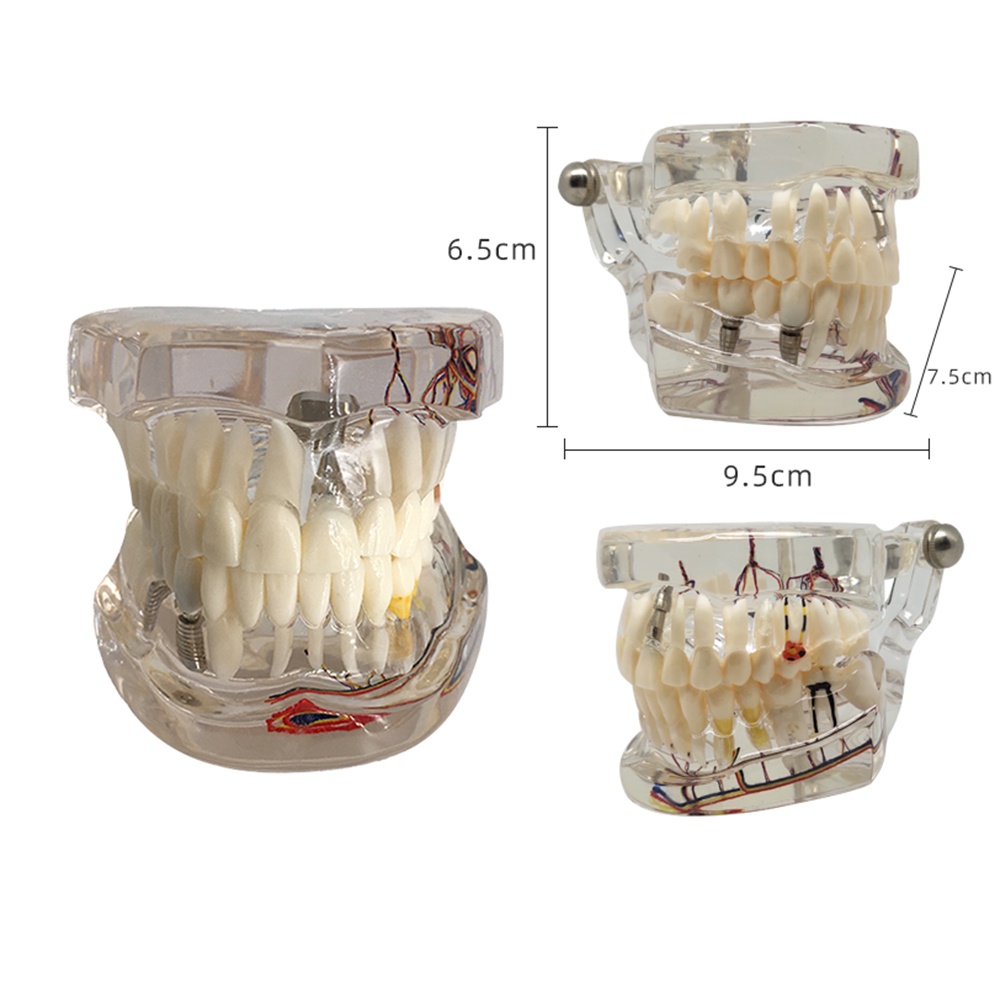 Dental Tooth Restoration Model Tooth with Nerve Restoration Model for ...