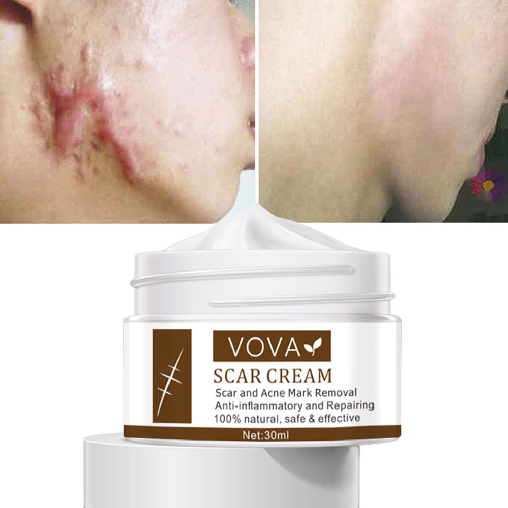 Chinese Medicine Scar Removal Cream Acne Spots Treatment for Burns Acne