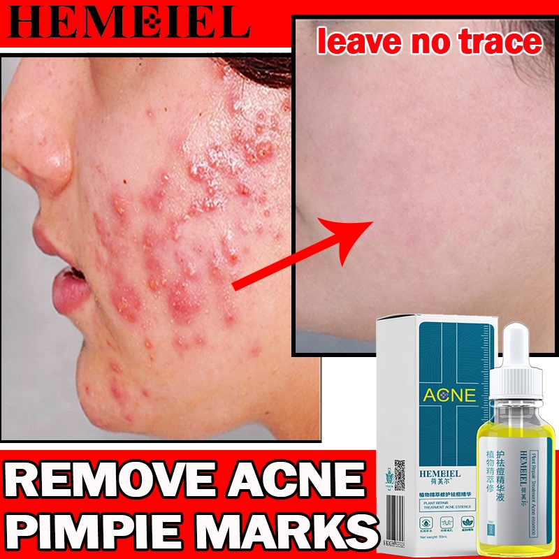 hemeiel-pimple-marks-remover-anti-acne-and-pimples-clindamycin-solution