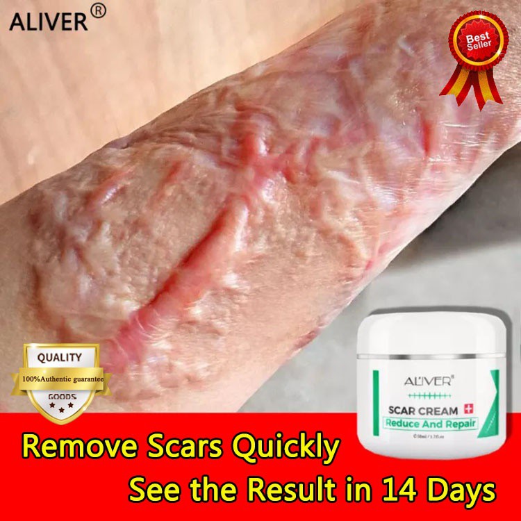 Skin ALIVER Scar Removal Cream 50ml Acne Spots Stretchmarks Burn Scar ...